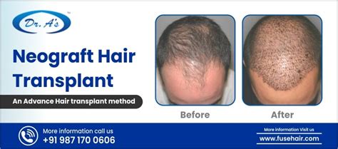 NeoGraft Advanced Hair Restoration .